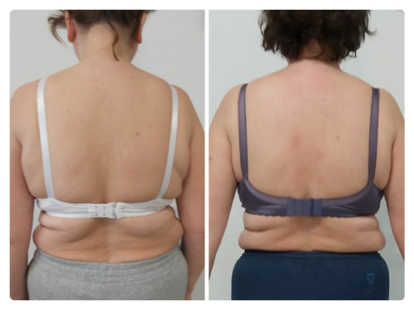 На першому фото зафіксована функціональна асиметрія тіла: підвищений тонус м’язів правої сторони, ротаційне зміщення грудного відділу та порушення горизонтального балансу плечового поясу. Пацієнтка суб’єктивно відчувала положення як «рівне», що характерно для зміненої тілесної схеми.  Після остеопатичної корекції відновлено м’язово-фасціальний баланс: плечовий пояс вирівнявся, зменшилася ротація та напруга, тіло повернулося до більш симетричного положення у просторі. Зміни відображають не «поставу», а глибоке відновлення нейром’язової координації та опори тіла.