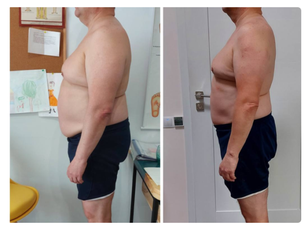 На першому фото зафіксована функціональна асиметрія тіла: підвищений тонус м’язів правої сторони, ротаційне зміщення грудного відділу та порушення горизонтального балансу плечового поясу. Пацієнтка суб’єктивно відчувала положення як «рівне», що характерно для зміненої тілесної схеми.  Після остеопатичної корекції відновлено м’язово-фасціальний баланс: плечовий пояс вирівнявся, зменшилася ротація та напруга, тіло повернулося до більш симетричного положення у просторі. Зміни відображають не «поставу», а глибоке відновлення нейром’язової координації та опори тіла.