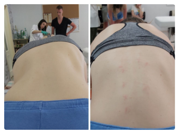 На першому фото зафіксована функціональна асиметрія тіла: підвищений тонус м’язів правої сторони, ротаційне зміщення грудного відділу та порушення горизонтального балансу плечового поясу. Пацієнтка суб’єктивно відчувала положення як «рівне», що характерно для зміненої тілесної схеми.  Після остеопатичної корекції відновлено м’язово-фасціальний баланс: плечовий пояс вирівнявся, зменшилася ротація та напруга, тіло повернулося до більш симетричного положення у просторі. Зміни відображають не «поставу», а глибоке відновлення нейром’язової координації та опори тіла.