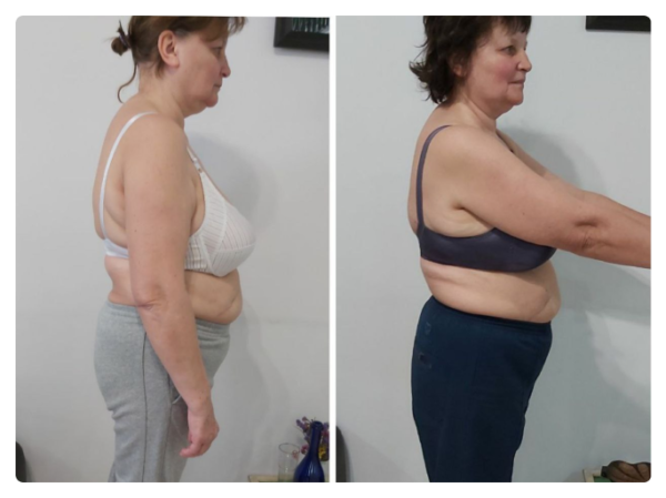 На першому фото зафіксована функціональна асиметрія тіла: підвищений тонус м’язів правої сторони, ротаційне зміщення грудного відділу та порушення горизонтального балансу плечового поясу. Пацієнтка суб’єктивно відчувала положення як «рівне», що характерно для зміненої тілесної схеми.  Після остеопатичної корекції відновлено м’язово-фасціальний баланс: плечовий пояс вирівнявся, зменшилася ротація та напруга, тіло повернулося до більш симетричного положення у просторі. Зміни відображають не «поставу», а глибоке відновлення нейром’язової координації та опори тіла.