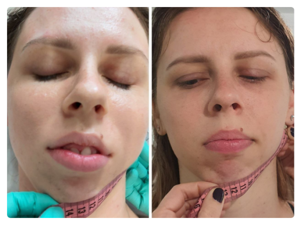 На першому фото зафіксована функціональна асиметрія тіла: підвищений тонус м’язів правої сторони, ротаційне зміщення грудного відділу та порушення горизонтального балансу плечового поясу. Пацієнтка суб’єктивно відчувала положення як «рівне», що характерно для зміненої тілесної схеми.  Після остеопатичної корекції відновлено м’язово-фасціальний баланс: плечовий пояс вирівнявся, зменшилася ротація та напруга, тіло повернулося до більш симетричного положення у просторі. Зміни відображають не «поставу», а глибоке відновлення нейром’язової координації та опори тіла.