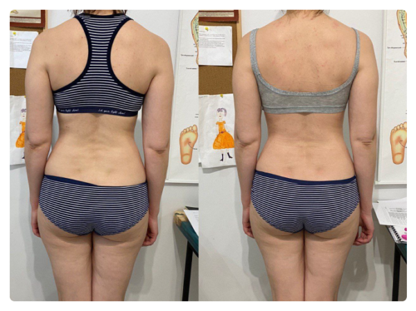 На першому фото зафіксована функціональна асиметрія тіла: підвищений тонус м’язів правої сторони, ротаційне зміщення грудного відділу та порушення горизонтального балансу плечового поясу. Пацієнтка суб’єктивно відчувала положення як «рівне», що характерно для зміненої тілесної схеми.  Після остеопатичної корекції відновлено м’язово-фасціальний баланс: плечовий пояс вирівнявся, зменшилася ротація та напруга, тіло повернулося до більш симетричного положення у просторі. Зміни відображають не «поставу», а глибоке відновлення нейром’язової координації та опори тіла.