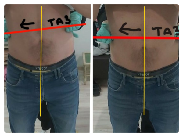 На першому фото зафіксована функціональна асиметрія тіла: підвищений тонус м’язів правої сторони, ротаційне зміщення грудного відділу та порушення горизонтального балансу плечового поясу. Пацієнтка суб’єктивно відчувала положення як «рівне», що характерно для зміненої тілесної схеми.  Після остеопатичної корекції відновлено м’язово-фасціальний баланс: плечовий пояс вирівнявся, зменшилася ротація та напруга, тіло повернулося до більш симетричного положення у просторі. Зміни відображають не «поставу», а глибоке відновлення нейром’язової координації та опори тіла.