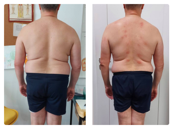 На першому фото зафіксована функціональна асиметрія тіла: підвищений тонус м’язів правої сторони, ротаційне зміщення грудного відділу та порушення горизонтального балансу плечового поясу. Пацієнтка суб’єктивно відчувала положення як «рівне», що характерно для зміненої тілесної схеми.  Після остеопатичної корекції відновлено м’язово-фасціальний баланс: плечовий пояс вирівнявся, зменшилася ротація та напруга, тіло повернулося до більш симетричного положення у просторі. Зміни відображають не «поставу», а глибоке відновлення нейром’язової координації та опори тіла.