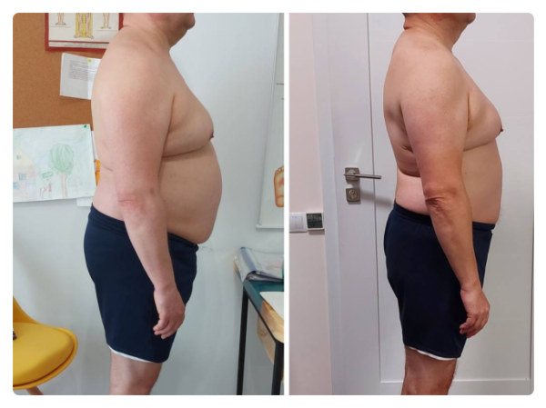 На першому фото зафіксована функціональна асиметрія тіла: підвищений тонус м’язів правої сторони, ротаційне зміщення грудного відділу та порушення горизонтального балансу плечового поясу. Пацієнтка суб’єктивно відчувала положення як «рівне», що характерно для зміненої тілесної схеми.  Після остеопатичної корекції відновлено м’язово-фасціальний баланс: плечовий пояс вирівнявся, зменшилася ротація та напруга, тіло повернулося до більш симетричного положення у просторі. Зміни відображають не «поставу», а глибоке відновлення нейром’язової координації та опори тіла.