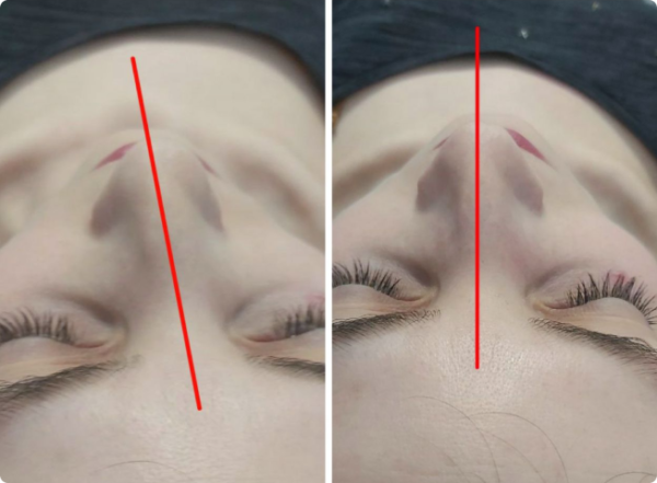 На першому фото зафіксована функціональна асиметрія тіла: підвищений тонус м’язів правої сторони, ротаційне зміщення грудного відділу та порушення горизонтального балансу плечового поясу. Пацієнтка суб’єктивно відчувала положення як «рівне», що характерно для зміненої тілесної схеми.  Після остеопатичної корекції відновлено м’язово-фасціальний баланс: плечовий пояс вирівнявся, зменшилася ротація та напруга, тіло повернулося до більш симетричного положення у просторі. Зміни відображають не «поставу», а глибоке відновлення нейром’язової координації та опори тіла.