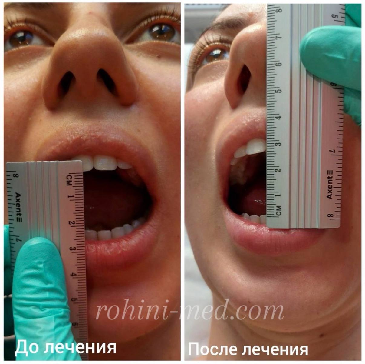 Реабілітація після невдалого стоматологічного та хірургічного втручання
Скарги: Блокування (заклинювання) скронево-нижньощелепного суглоба після маніпуляцій хірурга та ортодонта.
Робота: Остеопатичне розблокування суглоба, відновлення біомеханіки щелепи.
Результат: Значне збільшення амплітуди відкриття рота, зняття м'язового затиску та відновлення функціональності суглоба.