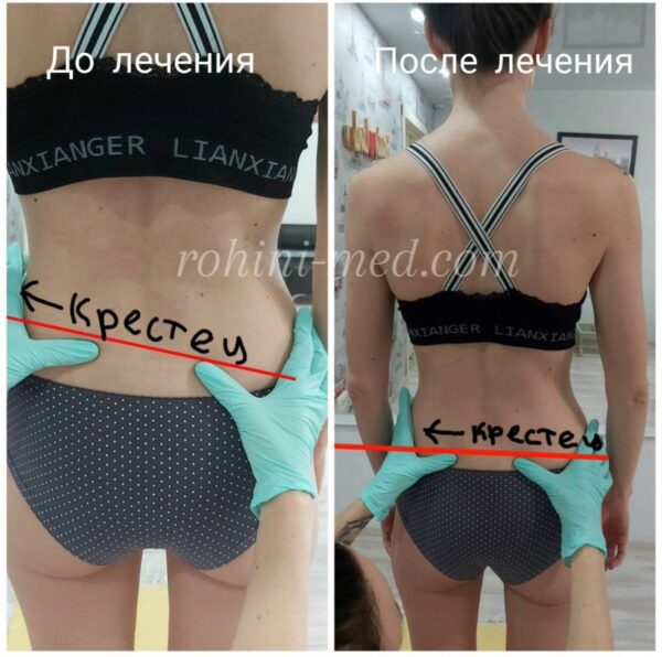 Корекція положення таза та відновлення симетрії
Робота: Вирівнювання рівня тазових кісток, усунення функціонального перекосу. Це фундаментальний етап для здоров’я всього хребта та рівномірного навантаження на нижні кінцівки.