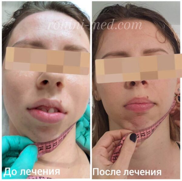Корекція асиметрії обличчя 
Робота з кутом нижньої щелепи та м’якими тканинами обличчя. Фото демонструє відновлення симетрії та гармонізацію контурів нижньої третини обличчя.