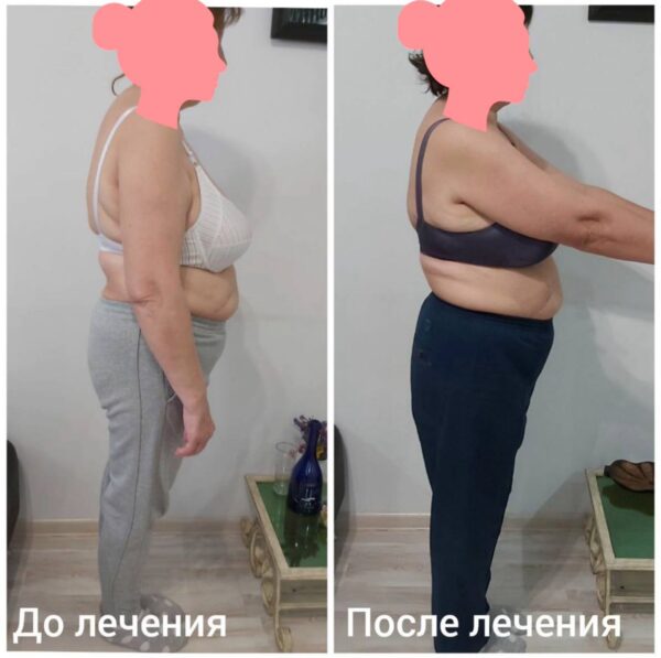 Вісцеральна терапія та системне оздоровлення Діагноз: Комплексна робота при нефропатії та паразитозі. Результат: Завдяки покращенню внутрішнього обміну та детоксикації організму спостерігається не лише фізіологічне покращення, а й виражений естетичний ефект: підтяжка тканин, природне схуднення та загальне омолодження вигляду.