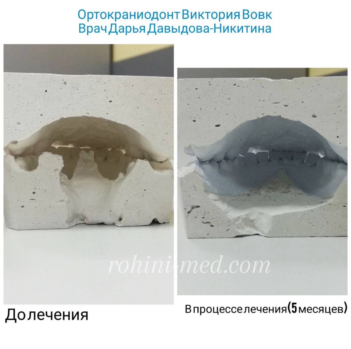 Ортокраніогнатологічне лікування (синергія фахівців)  Складна суміжна робота з кандидатом медичних наук Вовк В.В. Етапи: Лікування дисфункції СНЩС (скронево-нижньощелепного суглоба), використання сплінт-терапії з подальшим застосуванням апаратів для розширення верхньої і нижньої щелепи. Результат: Глибока структурна перебудова зубощелепної системи для досягнення стабільного функціонального та естетичного результату.