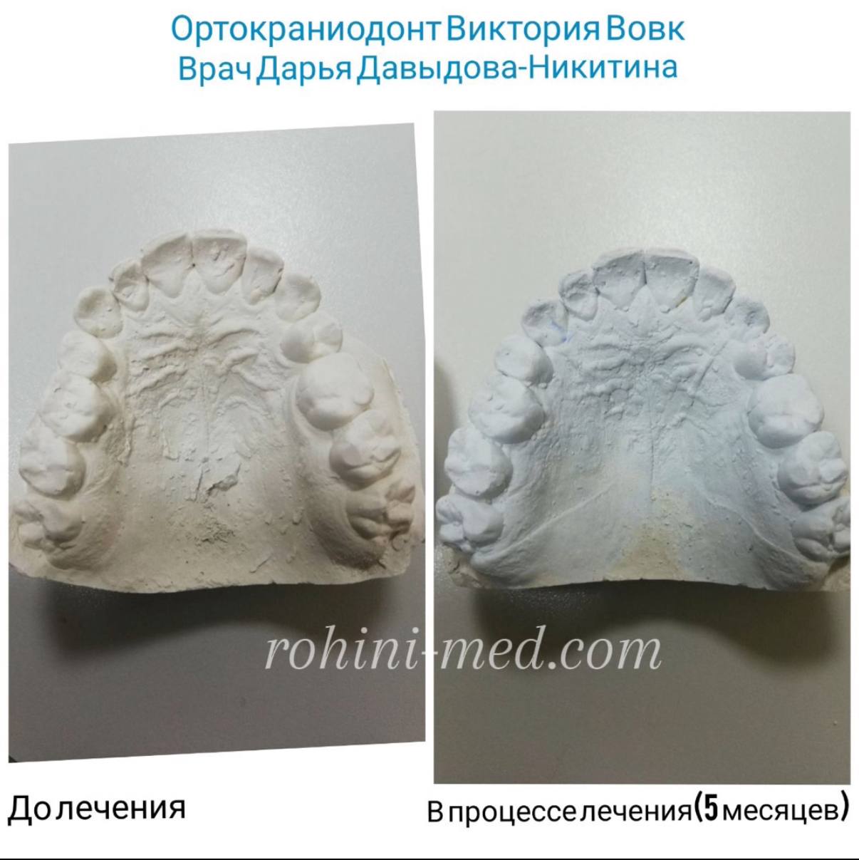 Ортокраніогнатологічне лікування (синергія фахівців)  Складна суміжна робота з кандидатом медичних наук Вовк В.В. Етапи: Лікування дисфункції СНЩС (скронево-нижньощелепного суглоба), використання сплінт-терапії з подальшим застосуванням апаратів для розширення верхньої щелепи. Результат: Глибока структурна перебудова зубощелепної системи для досягнення стабільного функціонального та естетичного результату.
