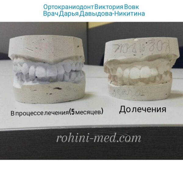 Ортокраніогнатологічне лікування (синергія фахівців)  Складна суміжна робота з кандидатом медичних наук Вовк В.В. Етапи: Лікування дисфункції СНЩС (скронево-нижньощелепного суглоба), використання сплінт-терапії з подальшим застосуванням апаратів для розширення щелеп. Результат: Глибока структурна перебудова зубощелепної системи для досягнення стабільного функціонального та естетичного результату.