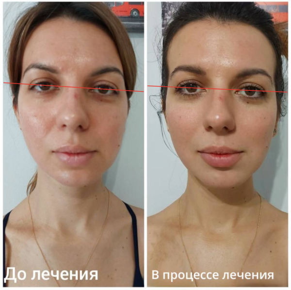 Кейс ортокраніодонтичного лікування. Підняття рівня очниці за рахунок створення правильної кісткової опори та роботи з біомеханікою швів черепа.