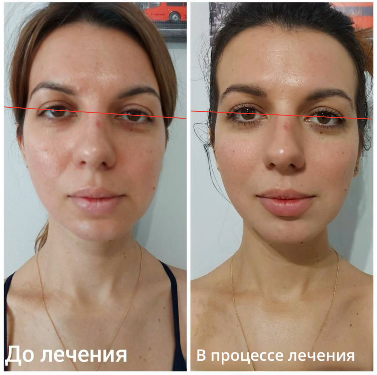 Кейс ортокраніодонтичного лікування. Підняття рівня очниці за рахунок створення правильної кісткової опори та роботи з біомеханікою швів черепа.